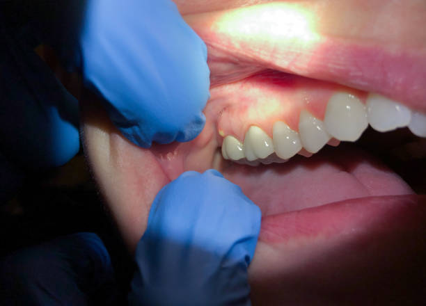 Best Urgent Care for Lost Fillings or Crowns in Lakewood, WA